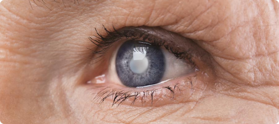 oeil cataracte