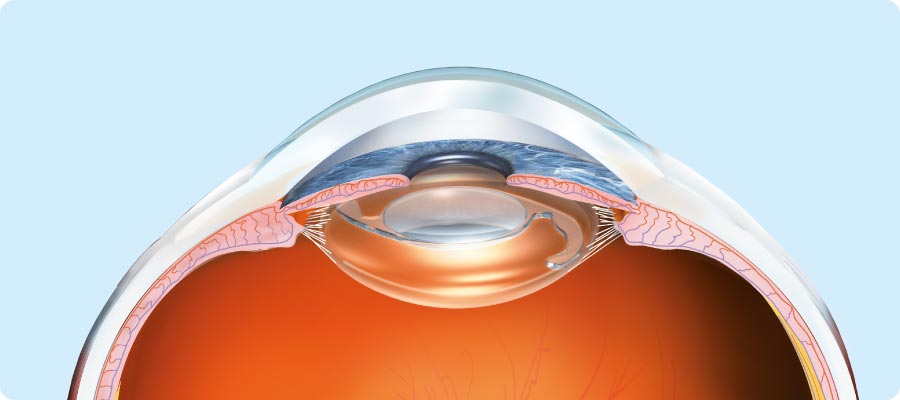 schémas oeil implant cataracte